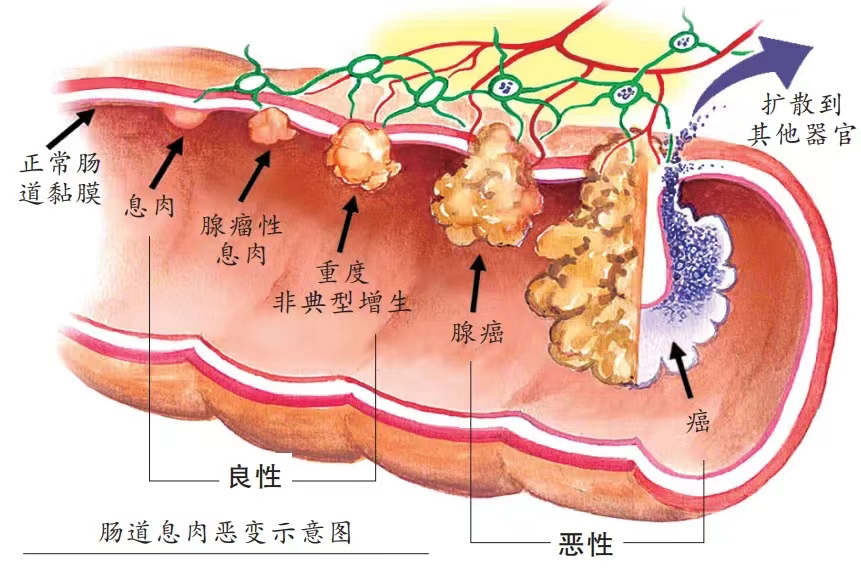 劫后余生,孩子的坚持让我躲过了肠癌1908 作者: 来源: 发布时间:2024-10-10 21:14